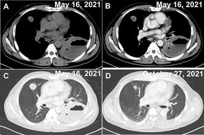 Primary pulmonary T-cell lymphoma after operation for small intestinal stromal tumor: A case report
